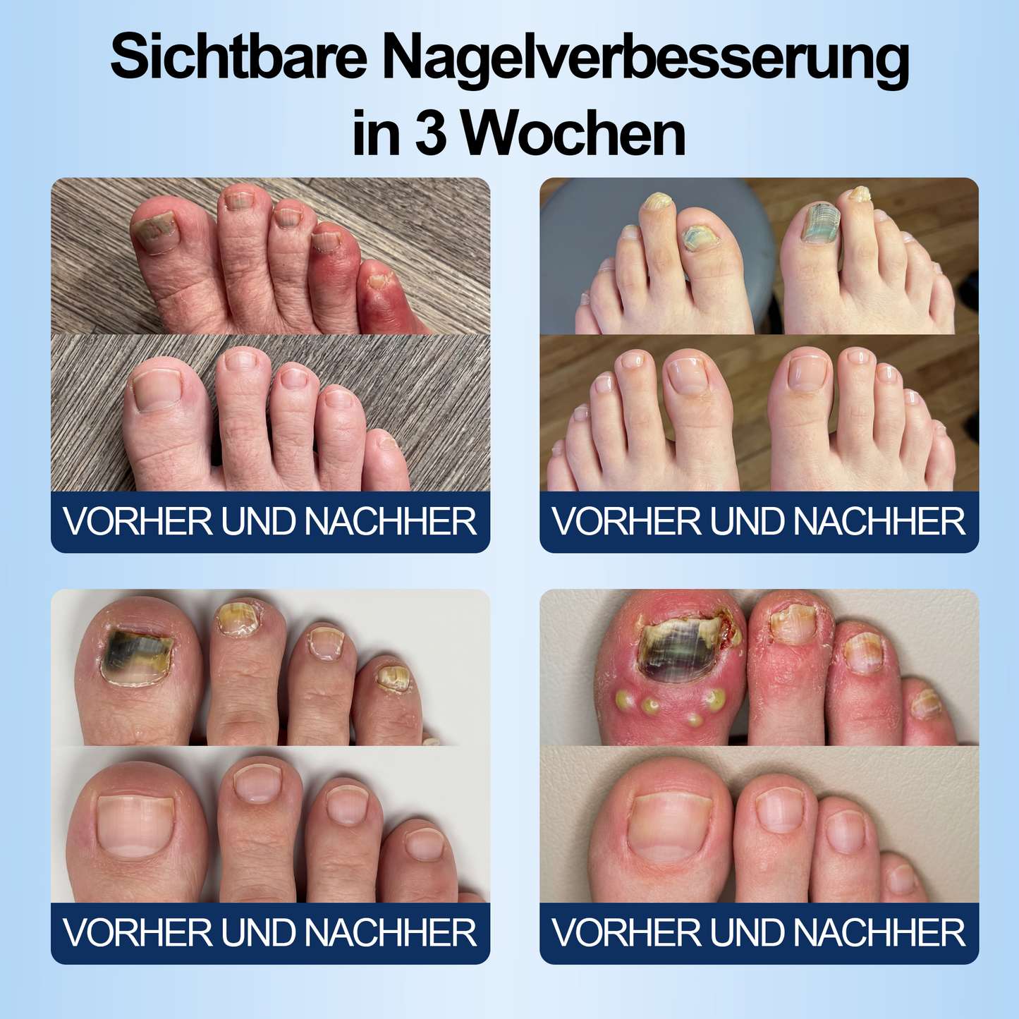 IYOCARE® Nagelpilz Reparatur-Stift Bekämpft die Ursache — Sichtbare Verbesserung in wenigen Tagen* Die meisten Behandlungen bleiben an der Oberfläche. Diese wirkt tiefer.