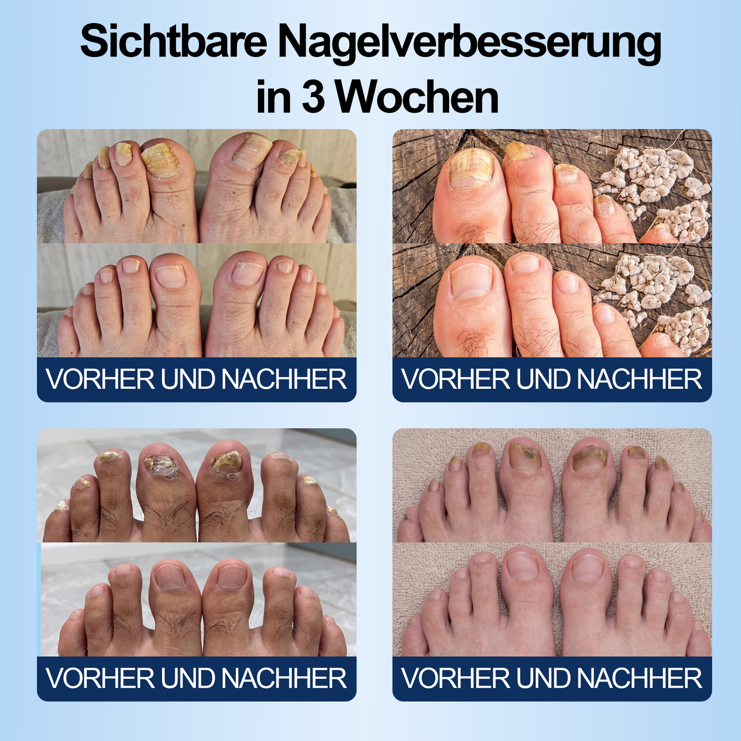IYOCARE® Nagelpilz Reparatur-Stift Bekämpft die Ursache — Sichtbare Verbesserung in wenigen Tagen* Die meisten Behandlungen bleiben an der Oberfläche. Diese wirkt tiefer.