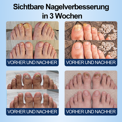 IYOCARE® Nagelpilz Reparatur-Stift Bekämpft die Ursache — Sichtbare Verbesserung in wenigen Tagen* Die meisten Behandlungen bleiben an der Oberfläche. Diese wirkt tiefer.