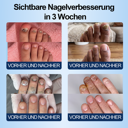 IYOCARE® Nagelpilz Reparatur-Stift Bekämpft die Ursache — Sichtbare Verbesserung in wenigen Tagen* Die meisten Behandlungen bleiben an der Oberfläche. Diese wirkt tiefer.
