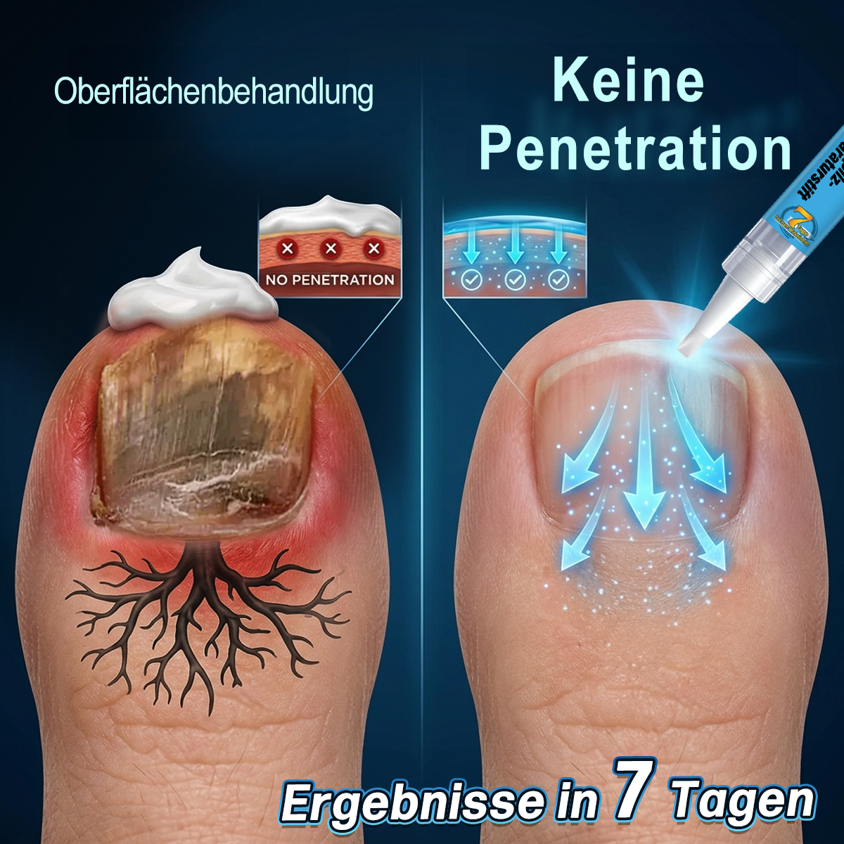 IYOCARE® Nagelpilz Reparatur-Stift Bekämpft die Ursache — Sichtbare Verbesserung in wenigen Tagen* Die meisten Behandlungen bleiben an der Oberfläche. Diese wirkt tiefer.