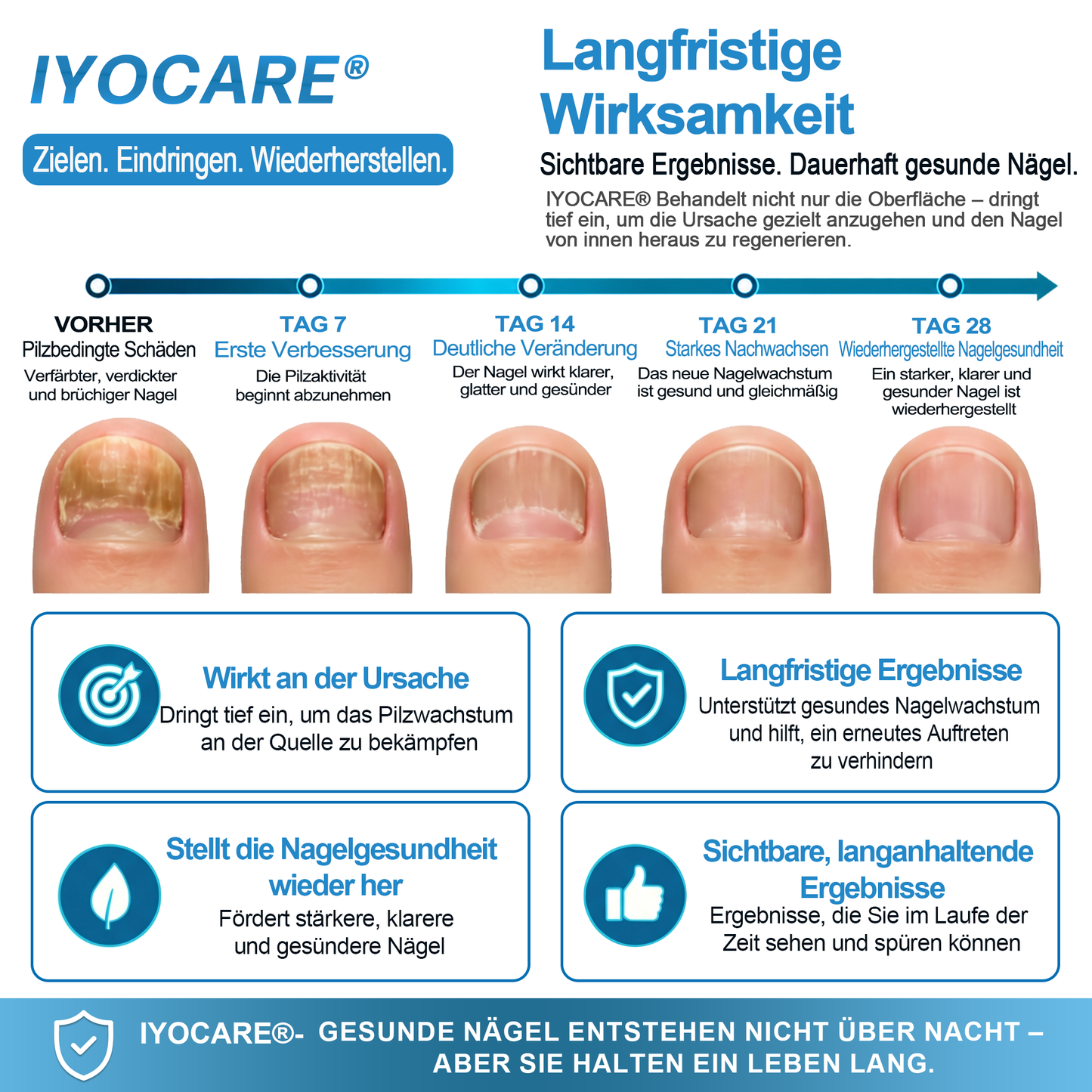 IYOCARE® Nagelpilz Reparatur-Stift Bekämpft die Ursache — Sichtbare Verbesserung in wenigen Tagen* Die meisten Behandlungen bleiben an der Oberfläche. Diese wirkt tiefer.